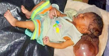 মাথায় বড় আকৃতির টিউমার নিয়ে সদ্য জন্ম নেয়া সন্তানকে নিয়ে বিপাকে পড়েছেন দিনমজুর বাবা