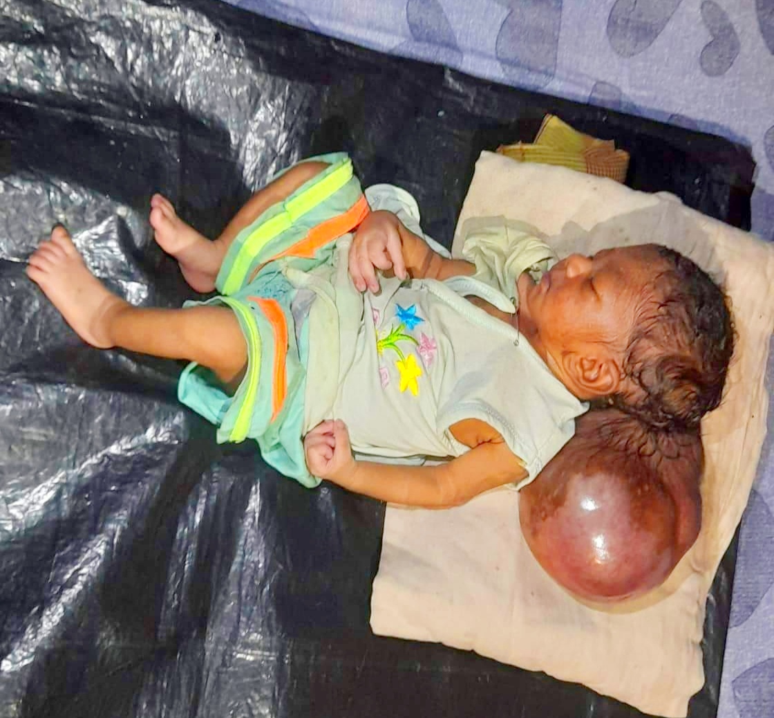 মাথায় বড় আকৃতির টিউমার নিয়ে সদ্য জন্ম নেয়া সন্তানকে নিয়ে বিপাকে পড়েছেন দিনমজুর বাবা