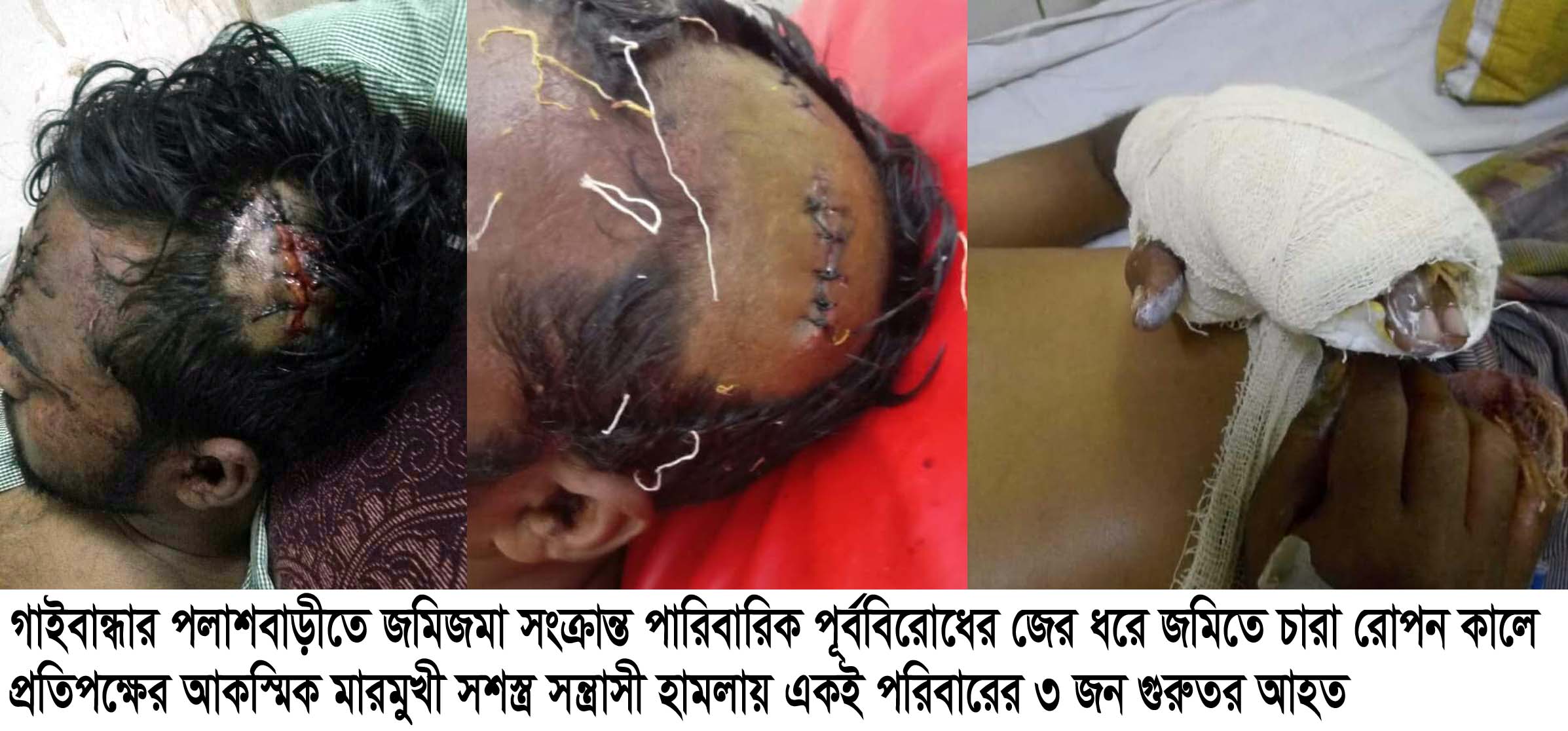 পলাশবাড়ীতে জমি-জমার বিরোধে মারামারি আহত ৫